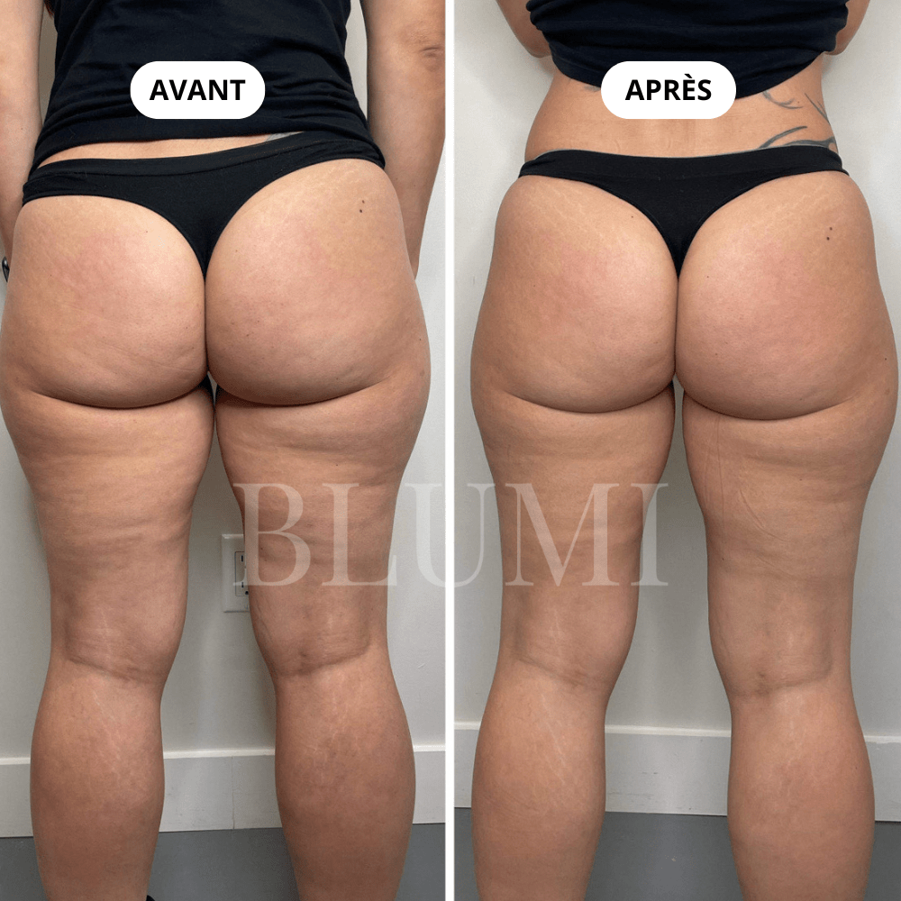 Short Anti - Cellulite Blumi - Blumi