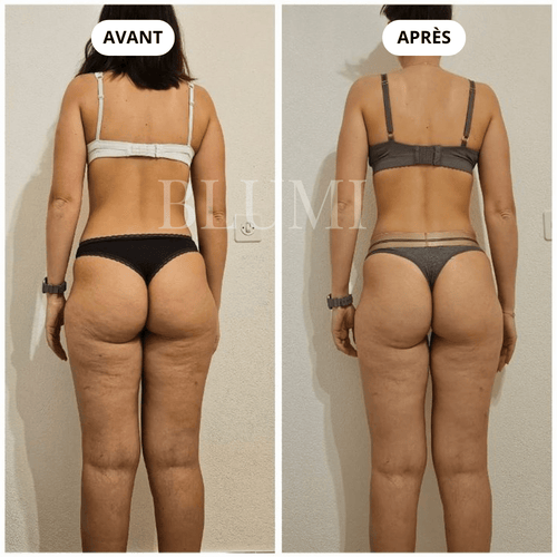 Short Anti-Cellulite Blumi